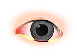 希瑪眼科中心_結膜炎症狀_分泌物增多